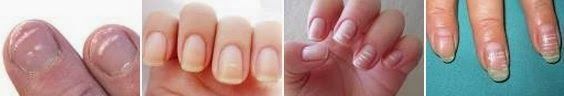 Uñas con Manchas Blancas 2 Uñas con Manchas Blancas 2