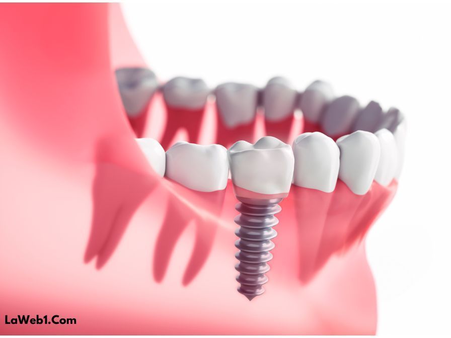 Implantes Dentales: Una Solución Duradera y Estética para la Pérdida Dental 3 Implantes Dentales: Una Solución Duradera y Estética para la Pérdida Dental 2